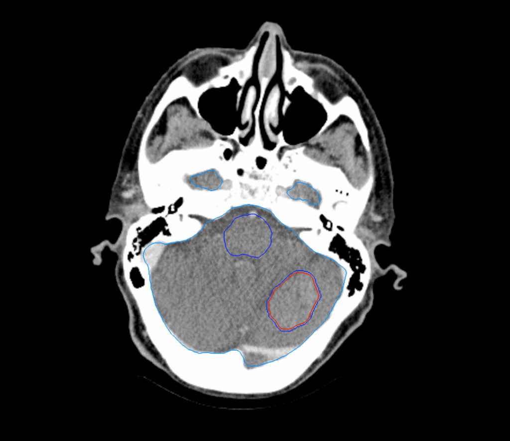 01 CT Axial Intracranial 1 Target