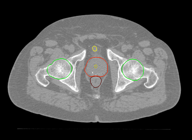 01 CT FFS Axial Prostate SBRT CK