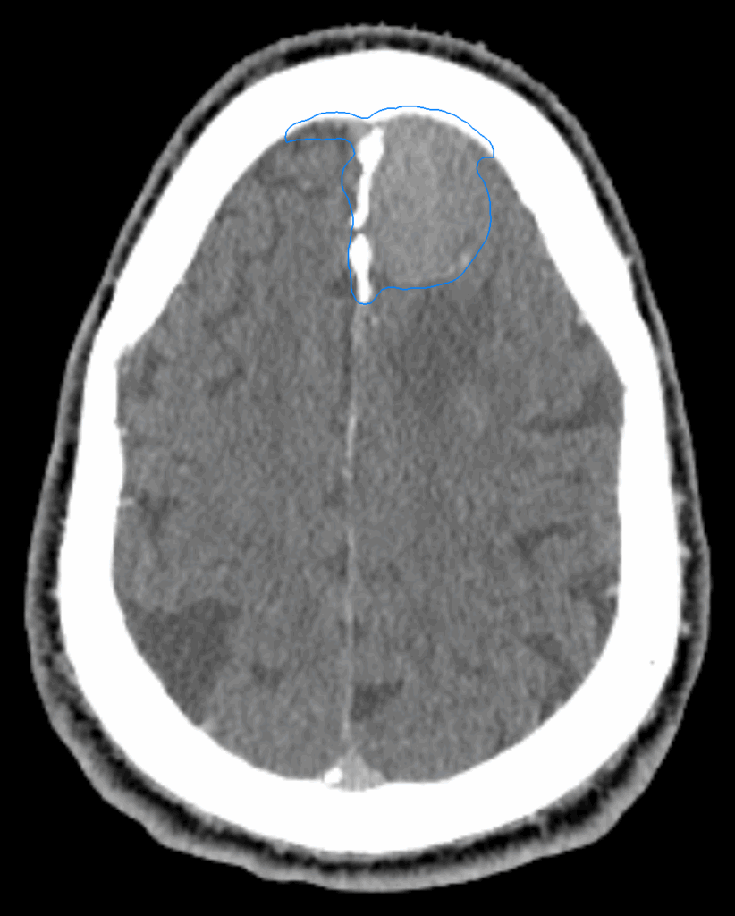 01 CT axial meningioma CK