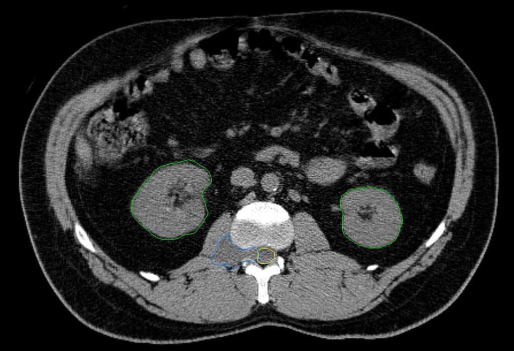 01 CT paraspinal meningioma CK