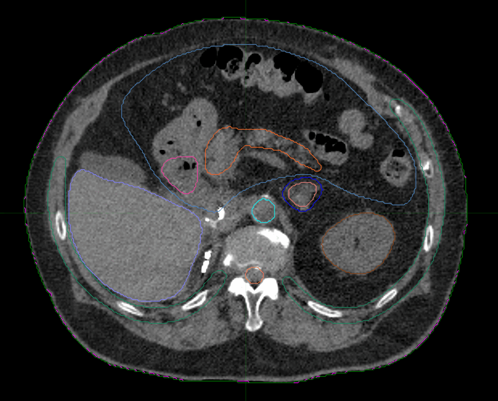 01-CT_axial_Adrenal