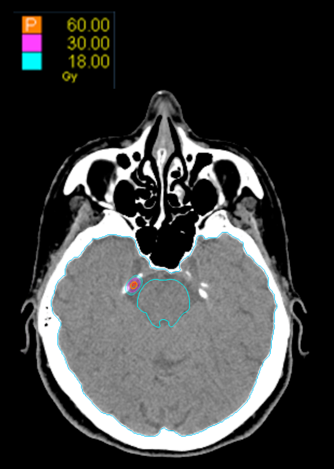 01 Dose Axial Trigeminal Neuralgia