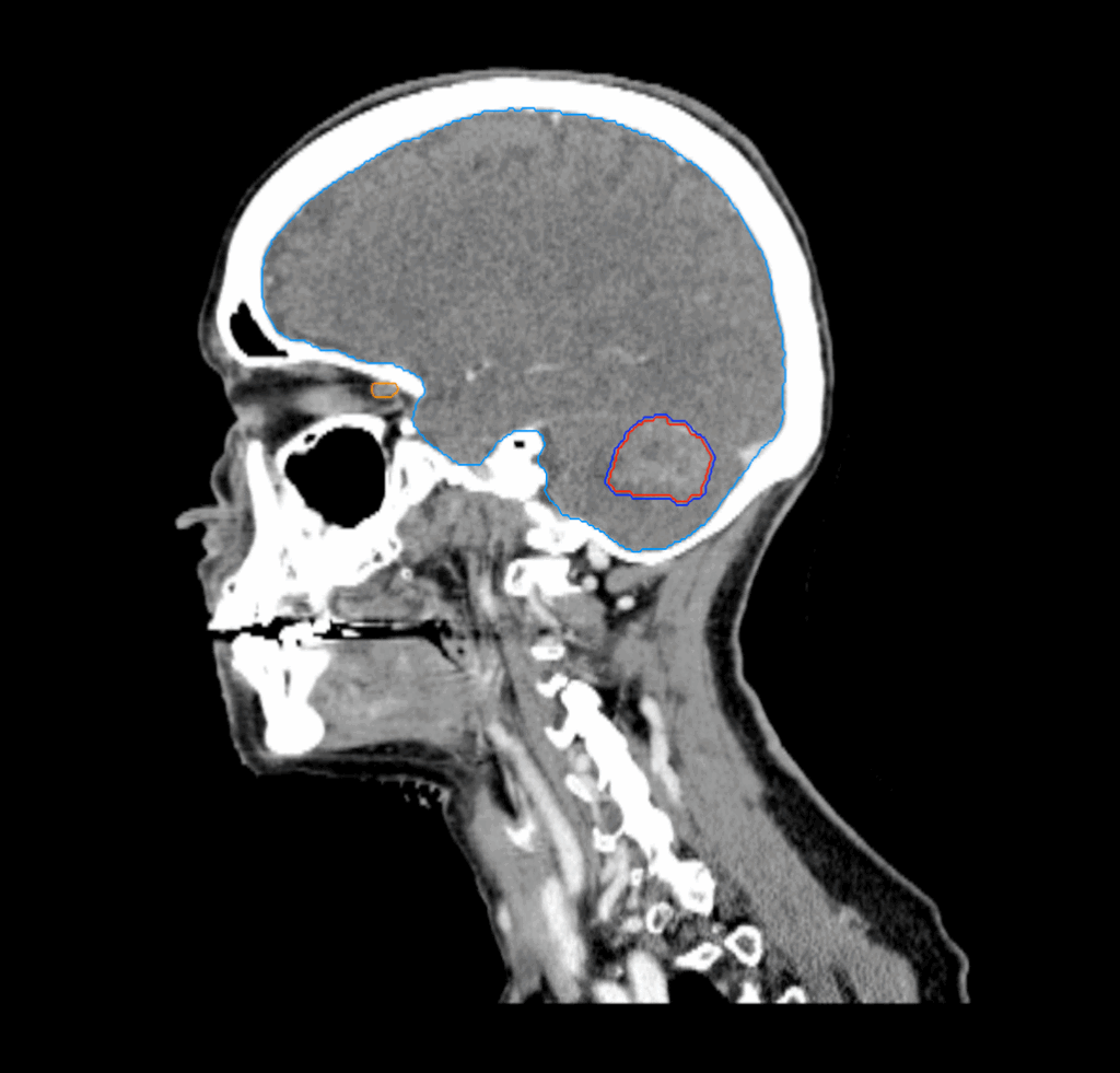 02 CT Sagittal Intracranial 1 Target