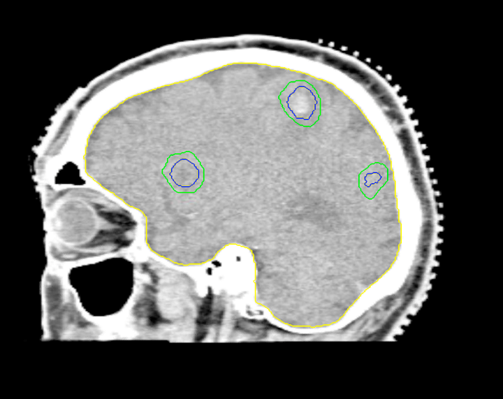 02 CT Sagittal Intracranial 8 Target