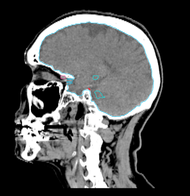 02 CT Sagittal Trigeminal Neuralgia
