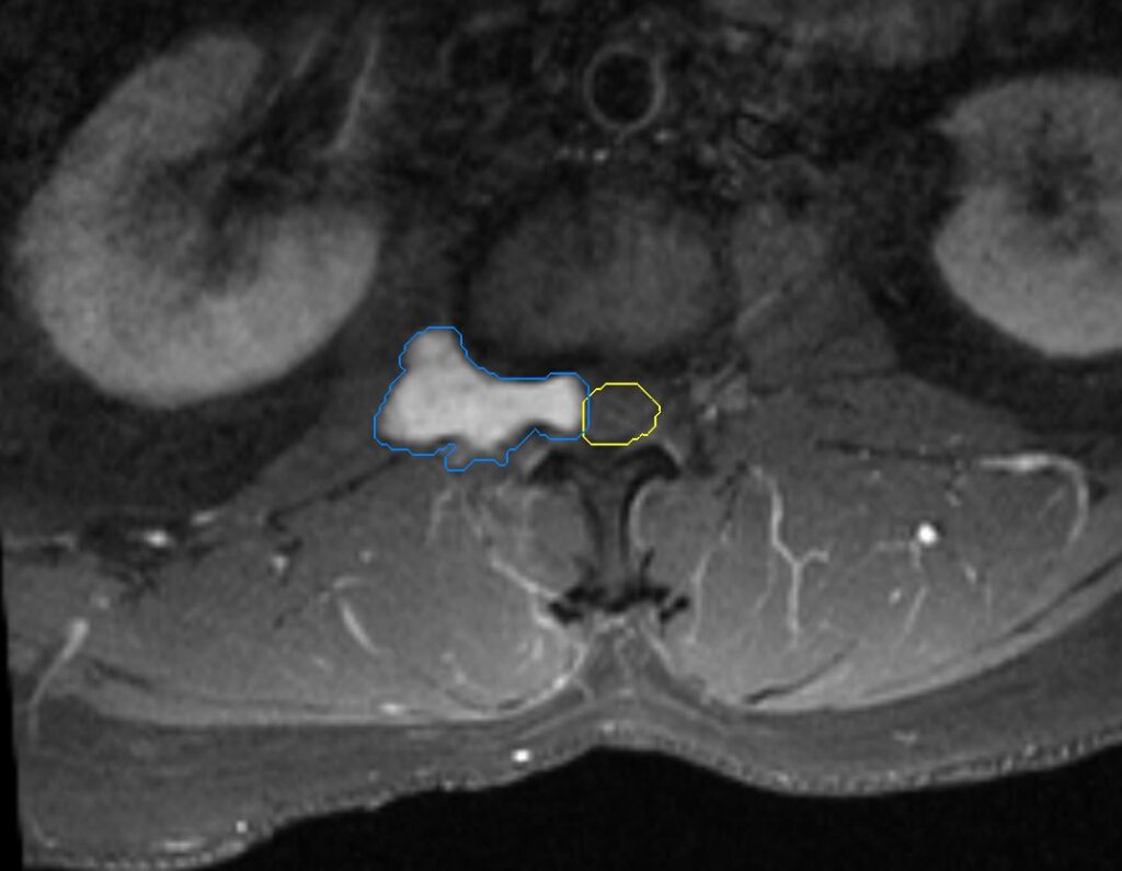 02 MRI paraspinal meningioma CK