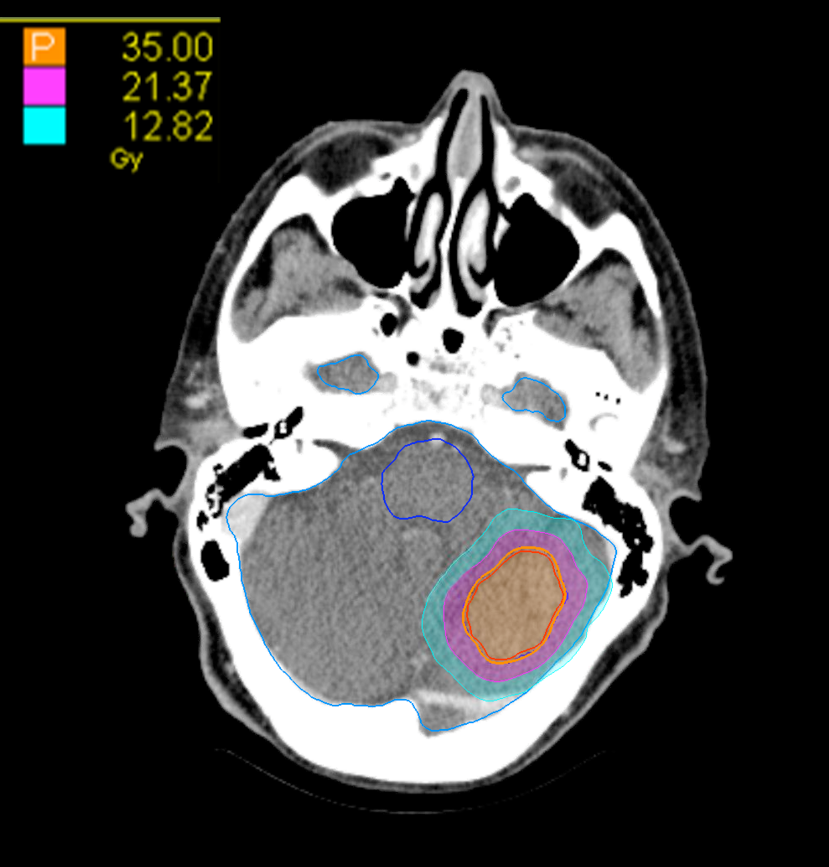 03 Dose Axial Intracranial 1 Target CK