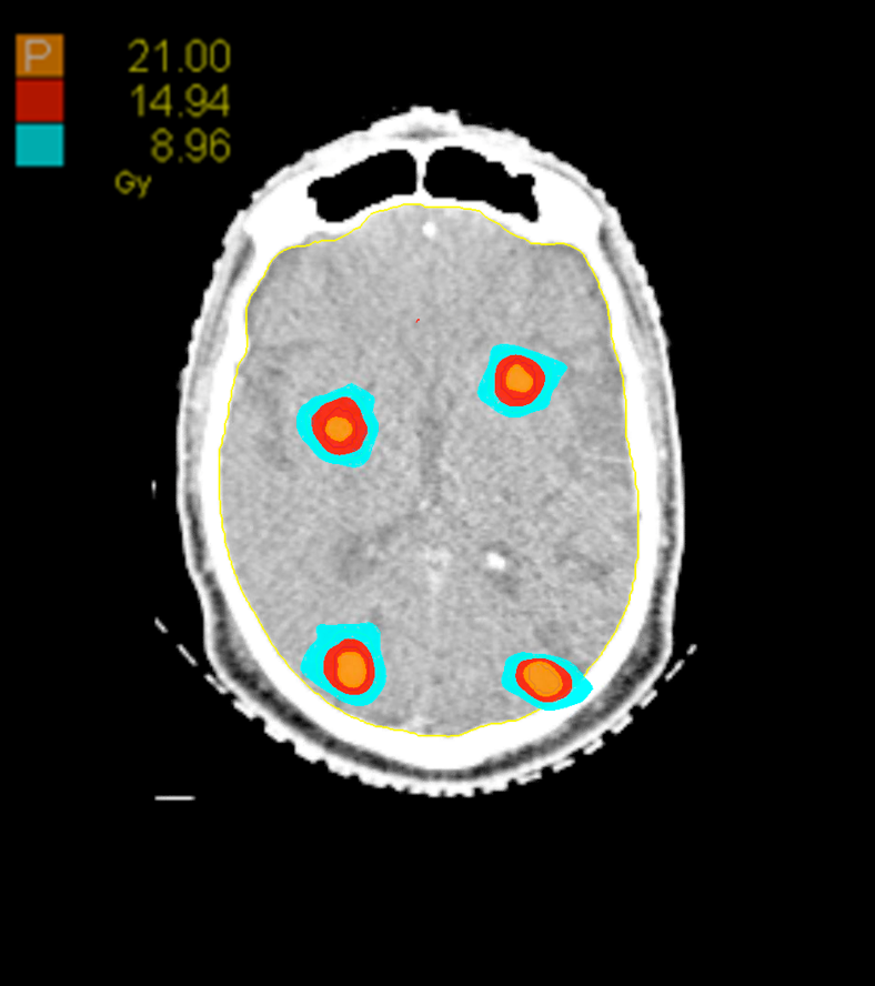 03 Dose Axial Intracranial 8 Target