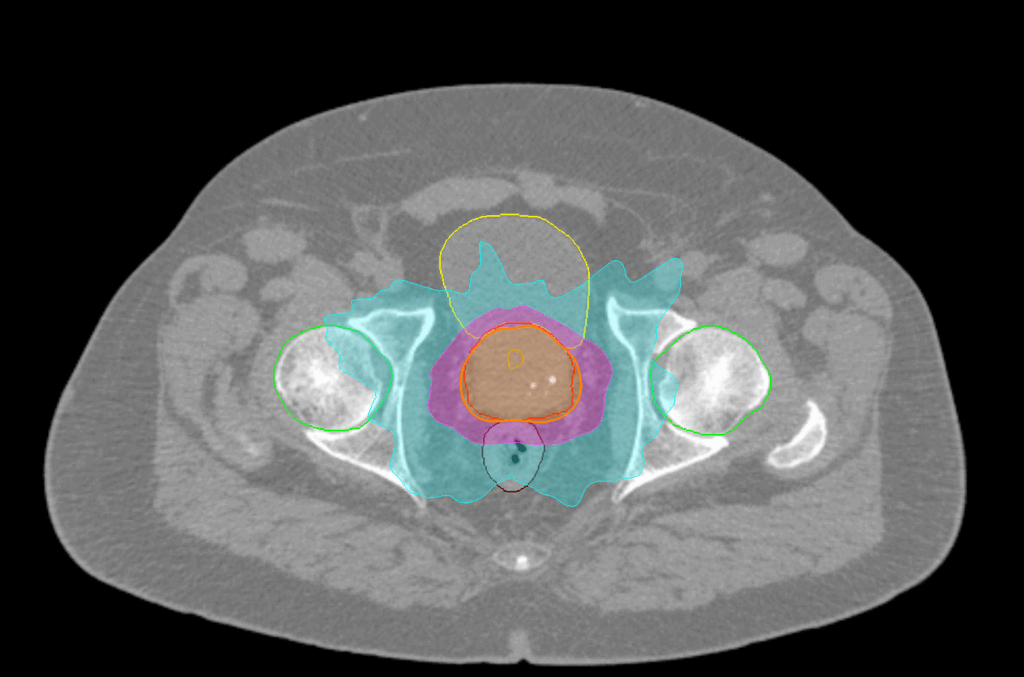 03 Dose FFS Axial Prostate SBRT CK - FOR SCREEN