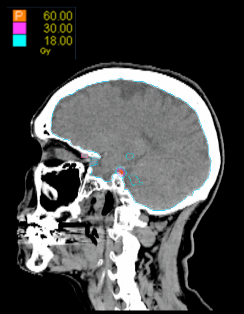 03 Dose Sagittal Trigeminal Neuralgia