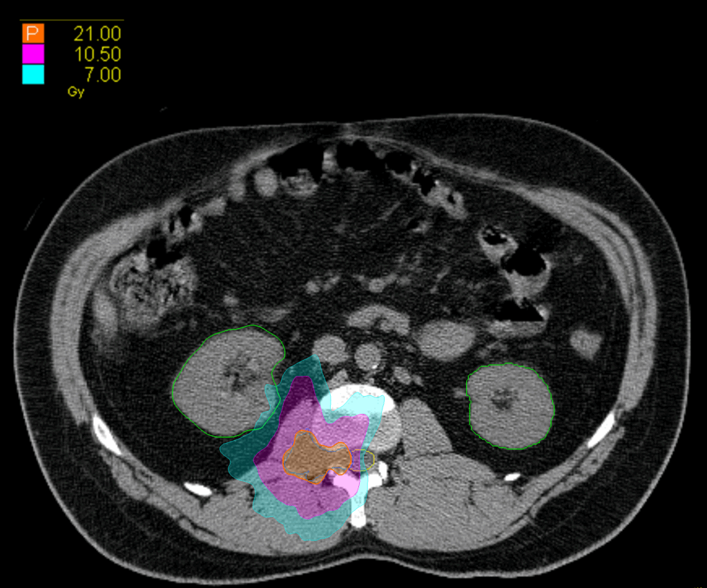 03 Dose axiale Paraspinal CK