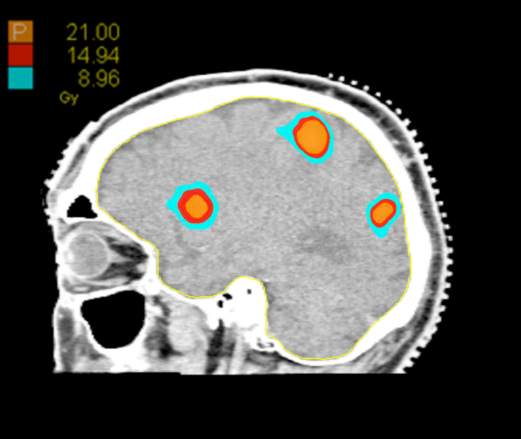 04 Dose Sagittal Intracranial 8 Target