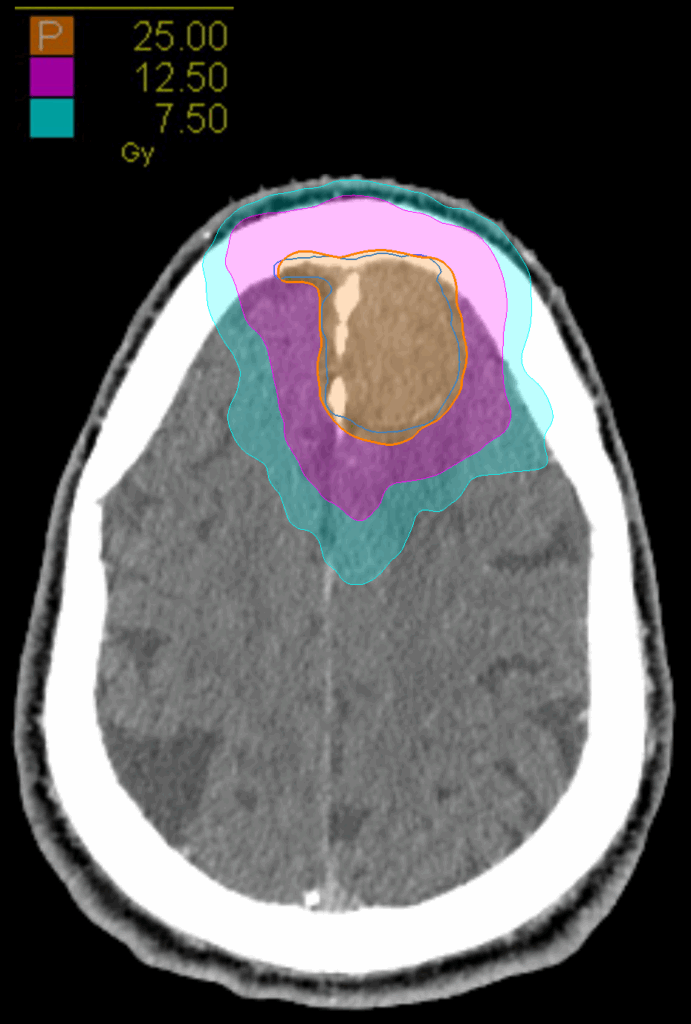 04 Dose axial meningioma CK