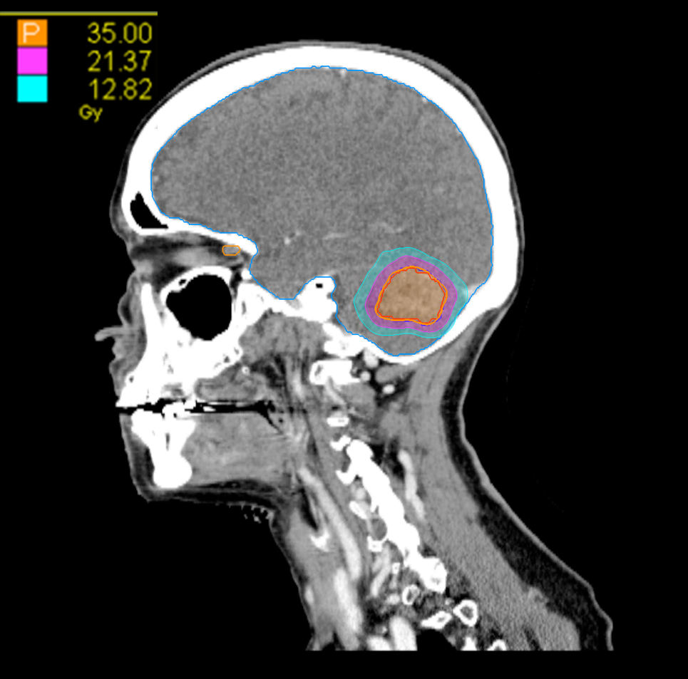 04 Dose sag Intracranial 1 Target CK