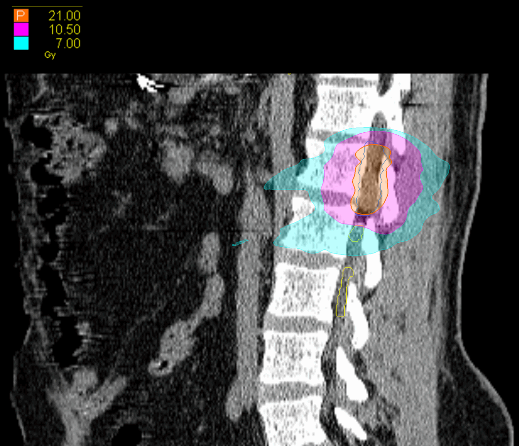 04 Dose sag Paraspinal CK
