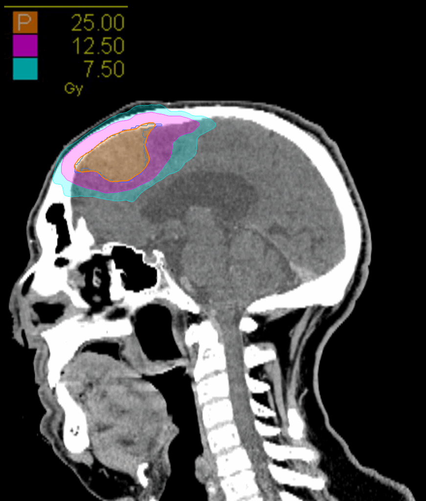 05 Dose sag meningioma CK