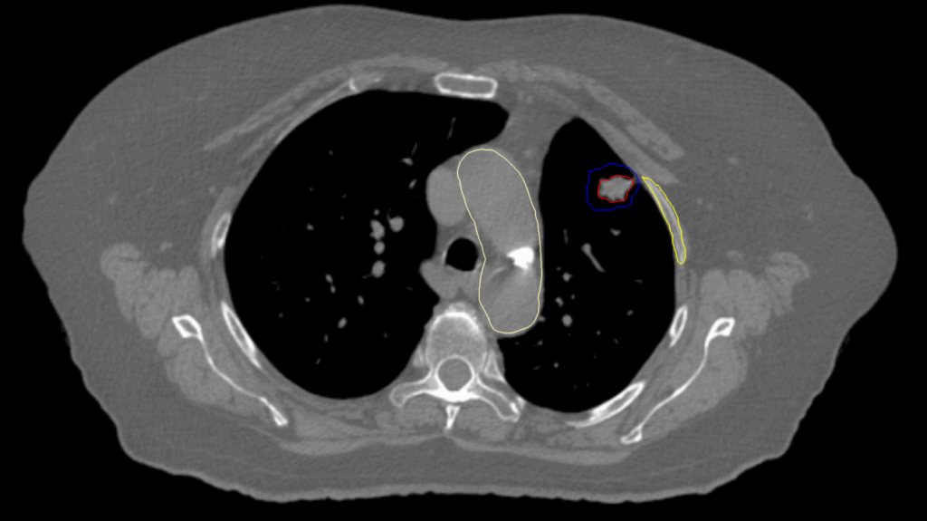13 CT Axial Lung MC CK