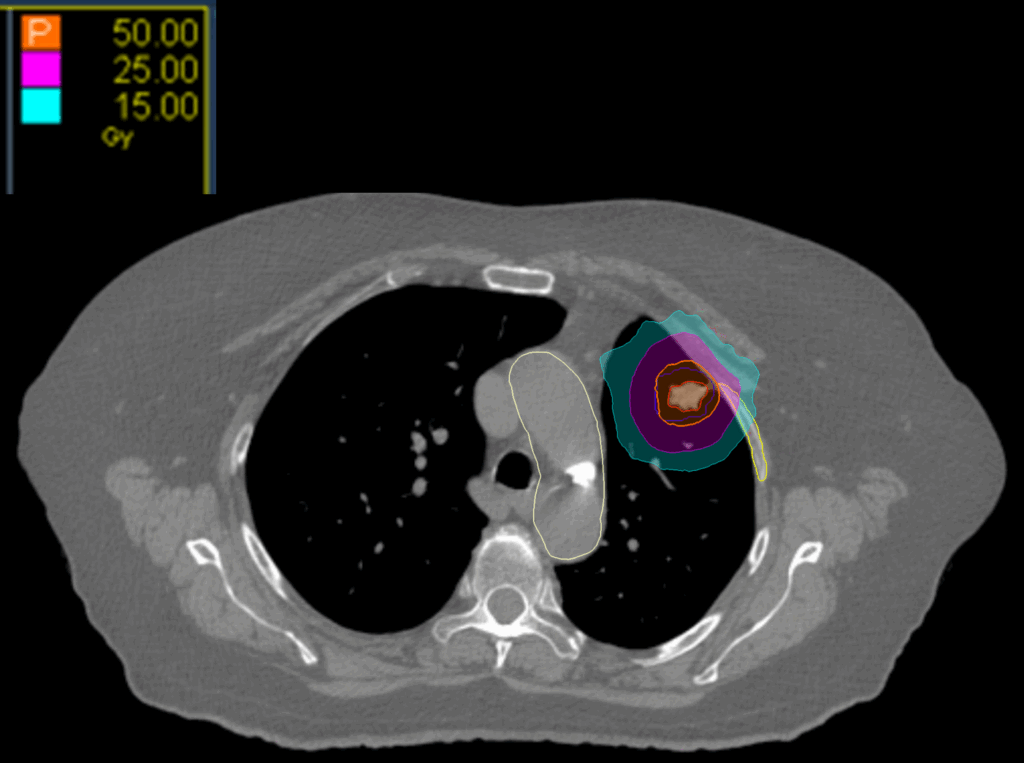 15 Dose Axial Lung MC CK