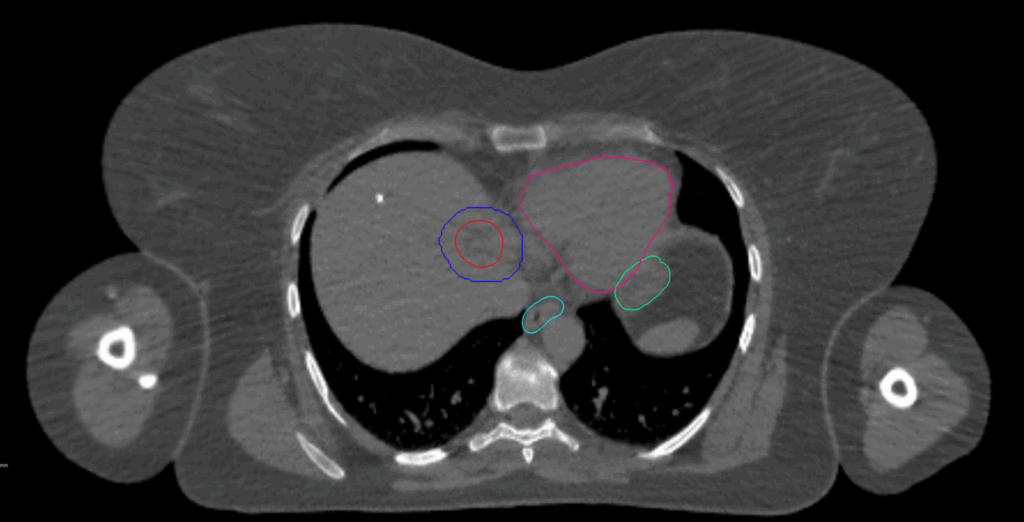 17 CT Axial Liver CK