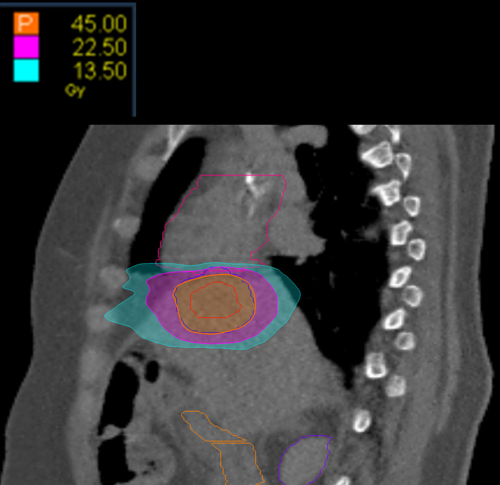 20 Dose sag Liver CK