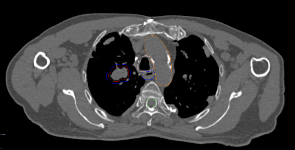 21 CT Axial Central Lung CK