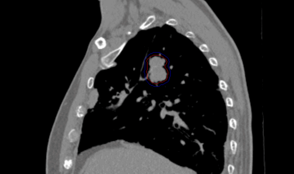22 CT Sag Central Lung CK