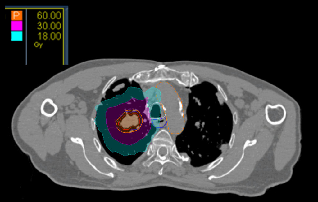 23 Dose Axial Central Lung CK