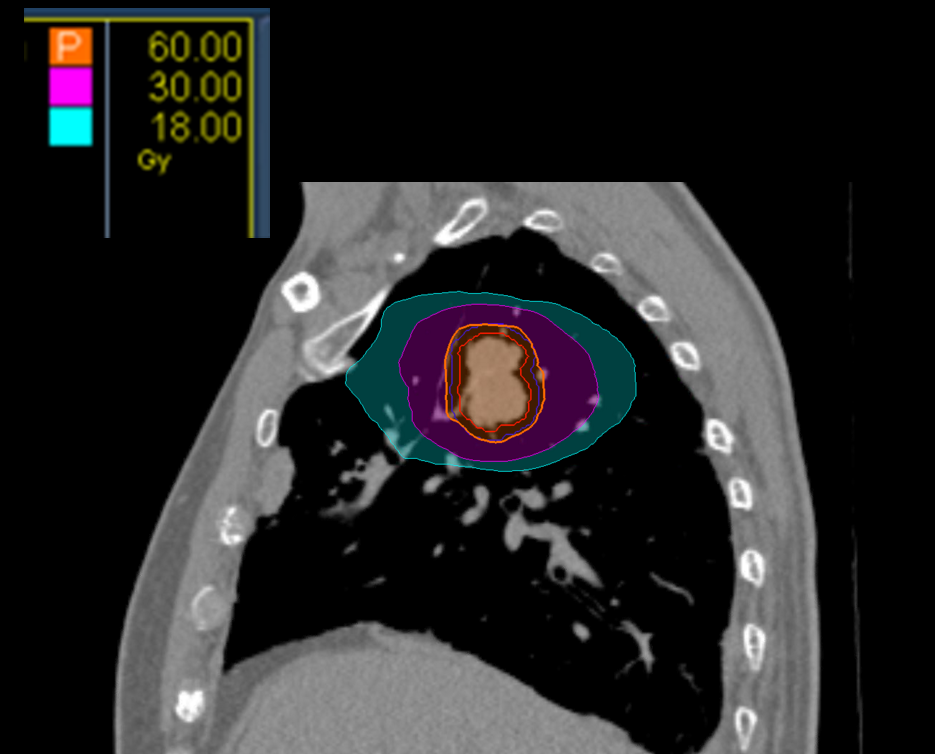 24 Dose Sag Central Lung CK