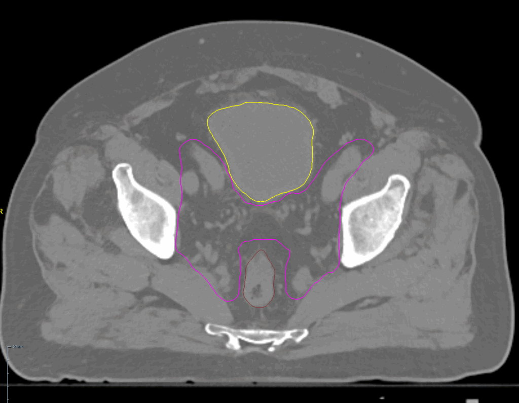 46+28 summation results - CT axial
