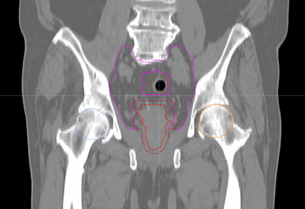46+28 summation results - CT coronal