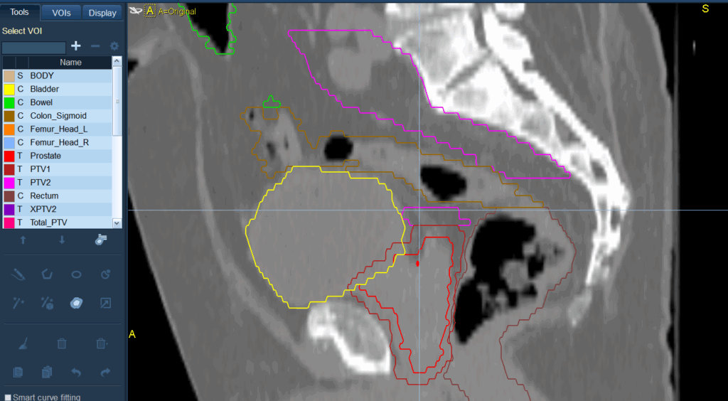 46+28 summation results - CTsag