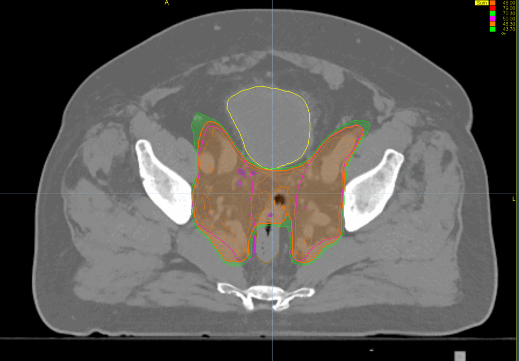 46+28 summation results - axial dose