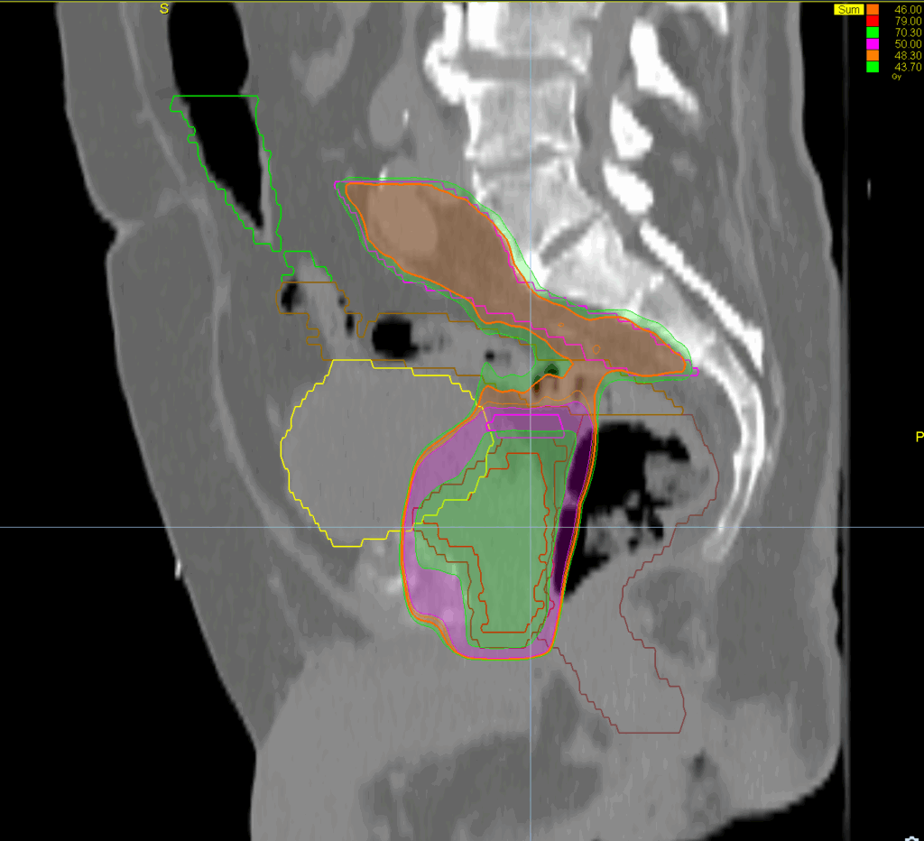 46+28 summation results - sag dose