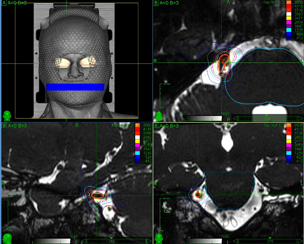trigeminal neuralgia radiotherapy plan