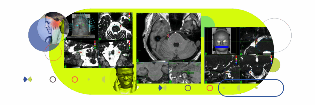 Trigeminal Neuralgia
