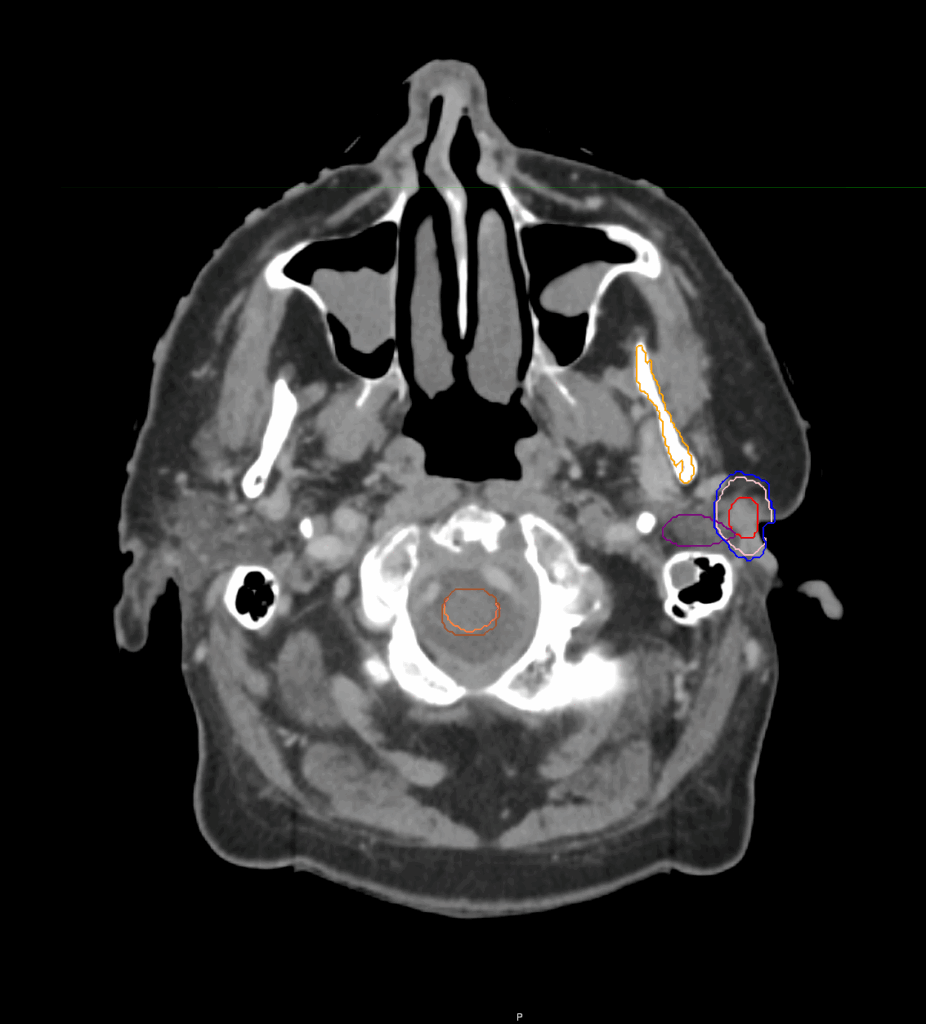 CT_Auditive duct_axial