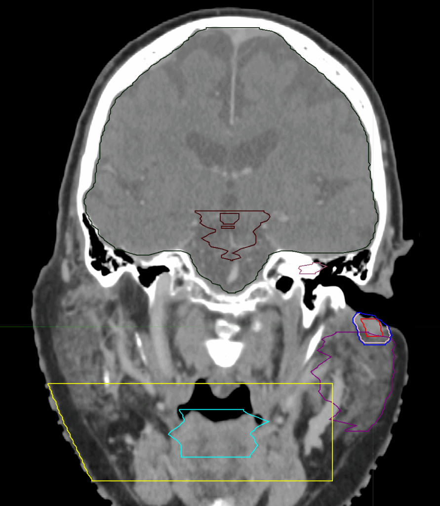 CT_Auditive duct_coronal