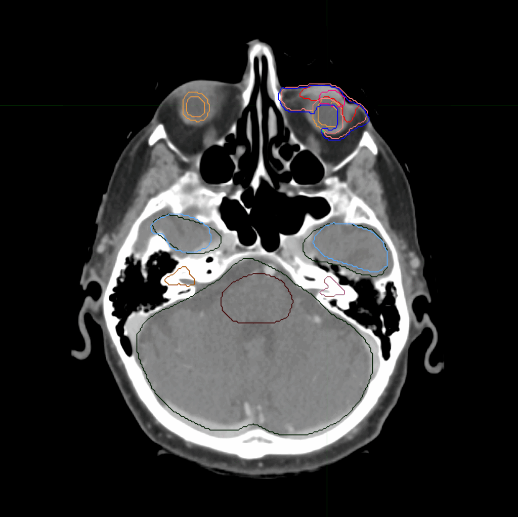 CT_Periocular_L_axial