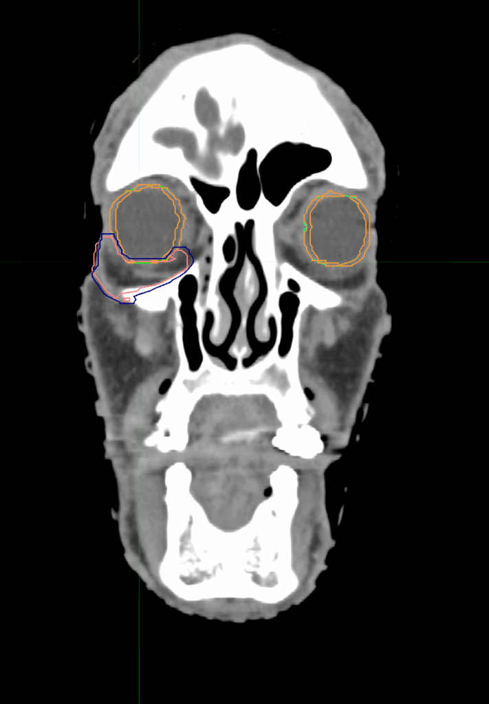 CT_Periocular_R_coronal