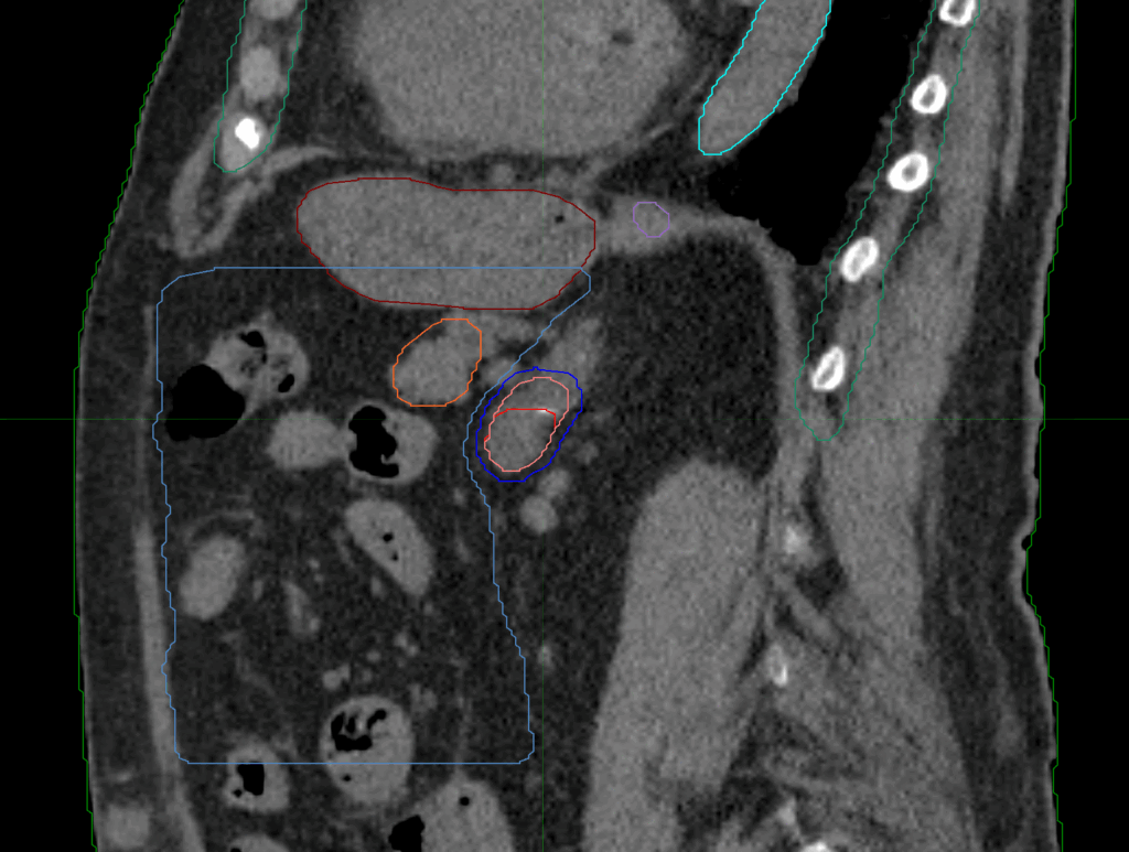 CT_sag_Aderenal