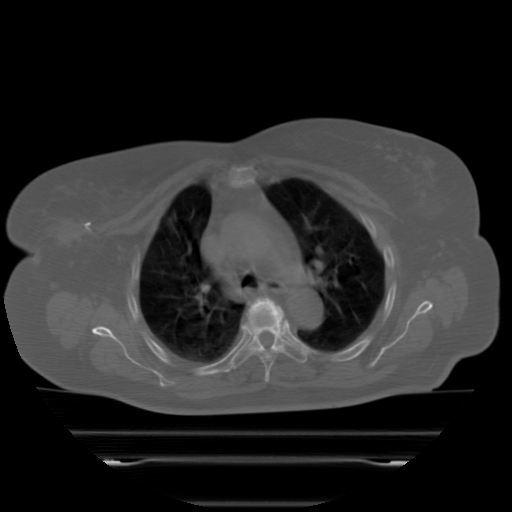 ClearRT Bilateral Breast Axial