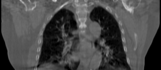 ClearRT Bilateral Breast Coronal