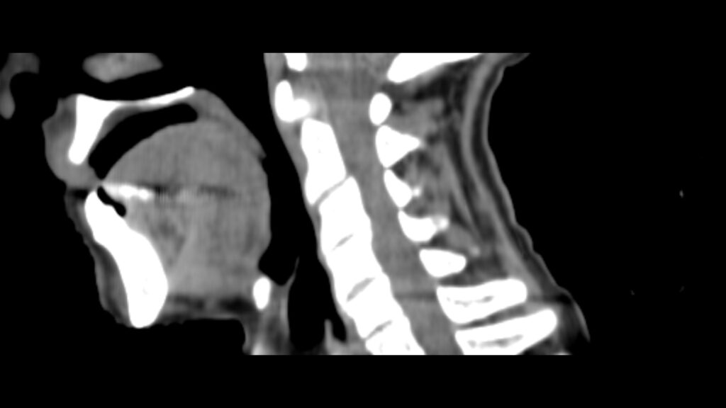 ClearRT Head and Neck fine sagittal
