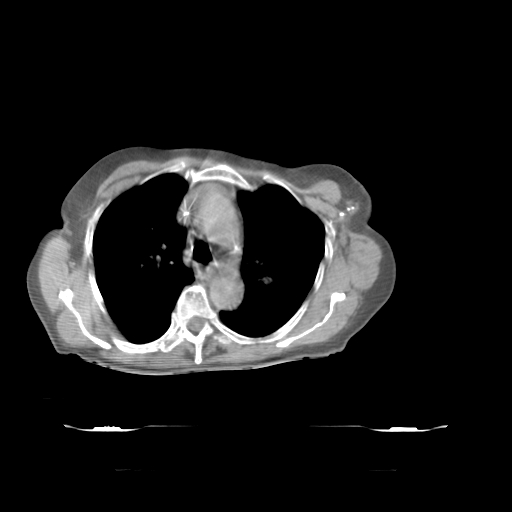 ClearRT L Breast Complex Axial