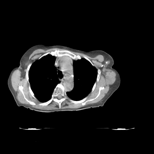 ClearRT L Breast Complex Axial