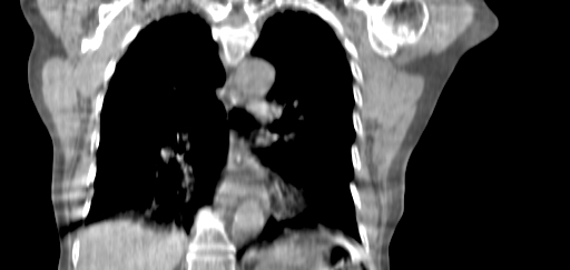 ClearRT L Breast Complex Coronal