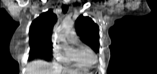 ClearRT L Breast Complex Coronal