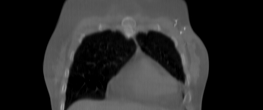 ClearRT L Breast Coronal