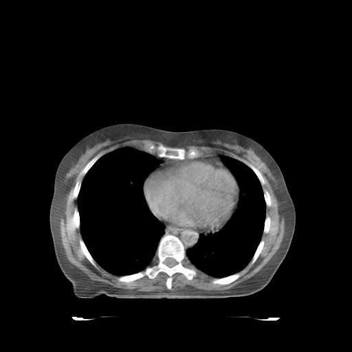ClearRT L Breast Heart Axial