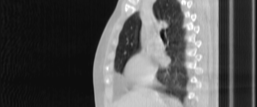 ClearRT L Breast Heart Sagittal